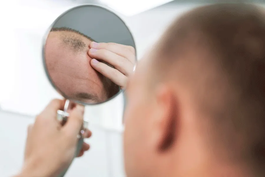 8 dicas para evitar o inchaço após o transplante de cabelo